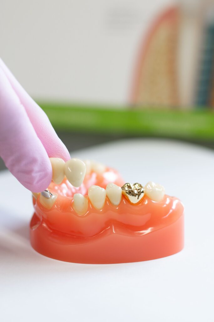 Couronne dentaire Nice - Restauration d'une dent endommagée